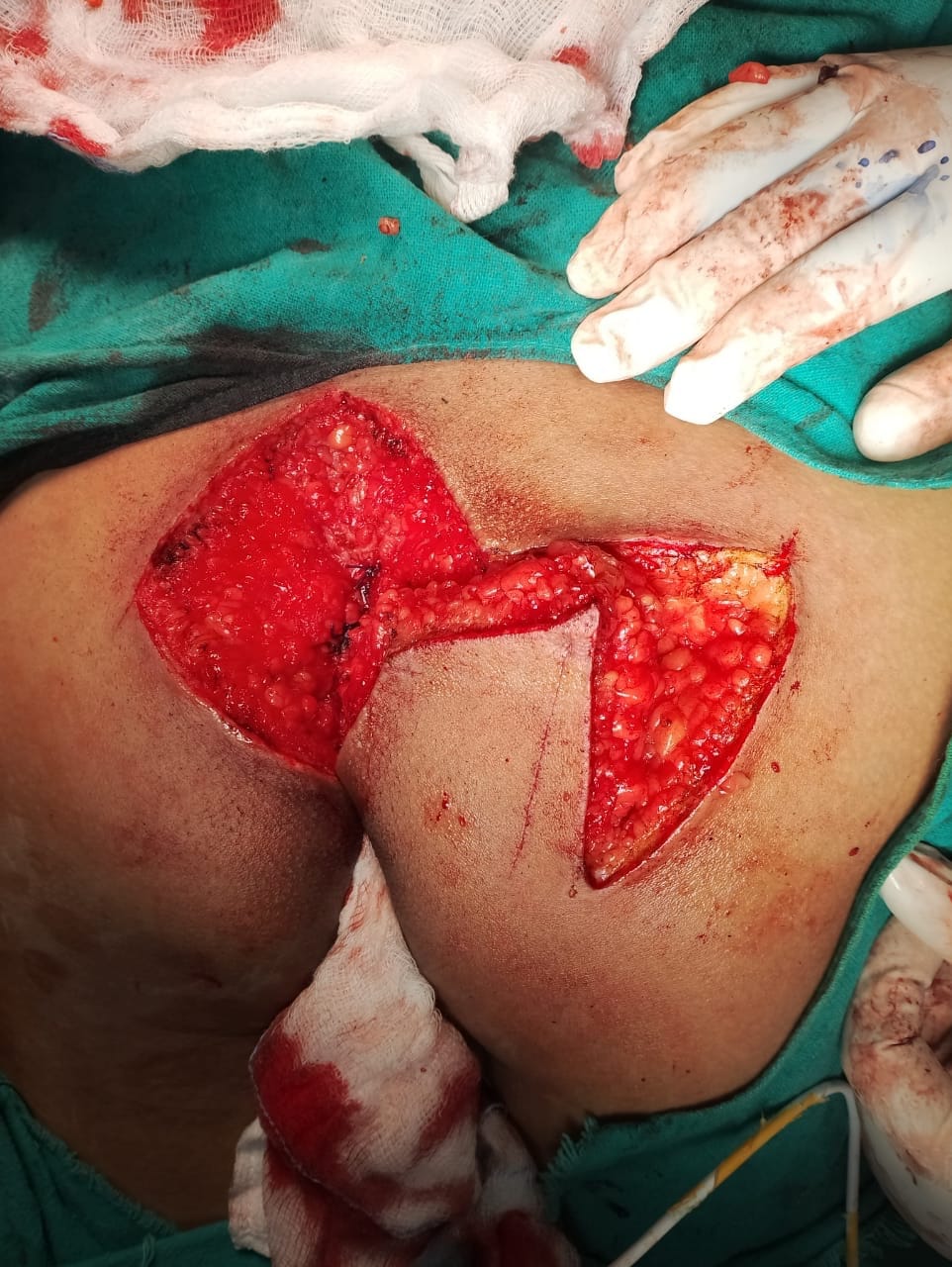 Complex laparoscopic cholecystectomy