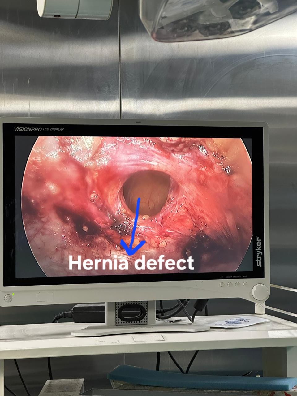 Cholecystoduodenal fistula repair
