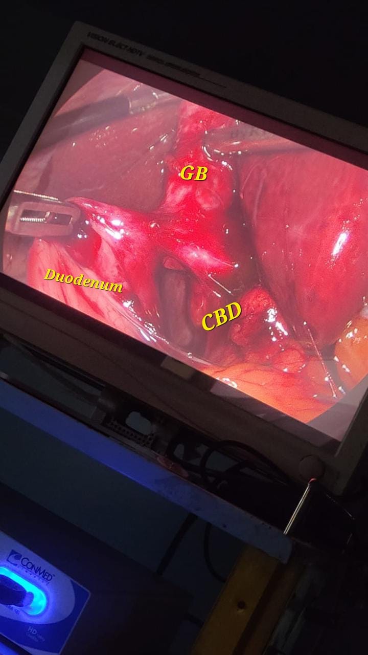 Hernia defect after closure