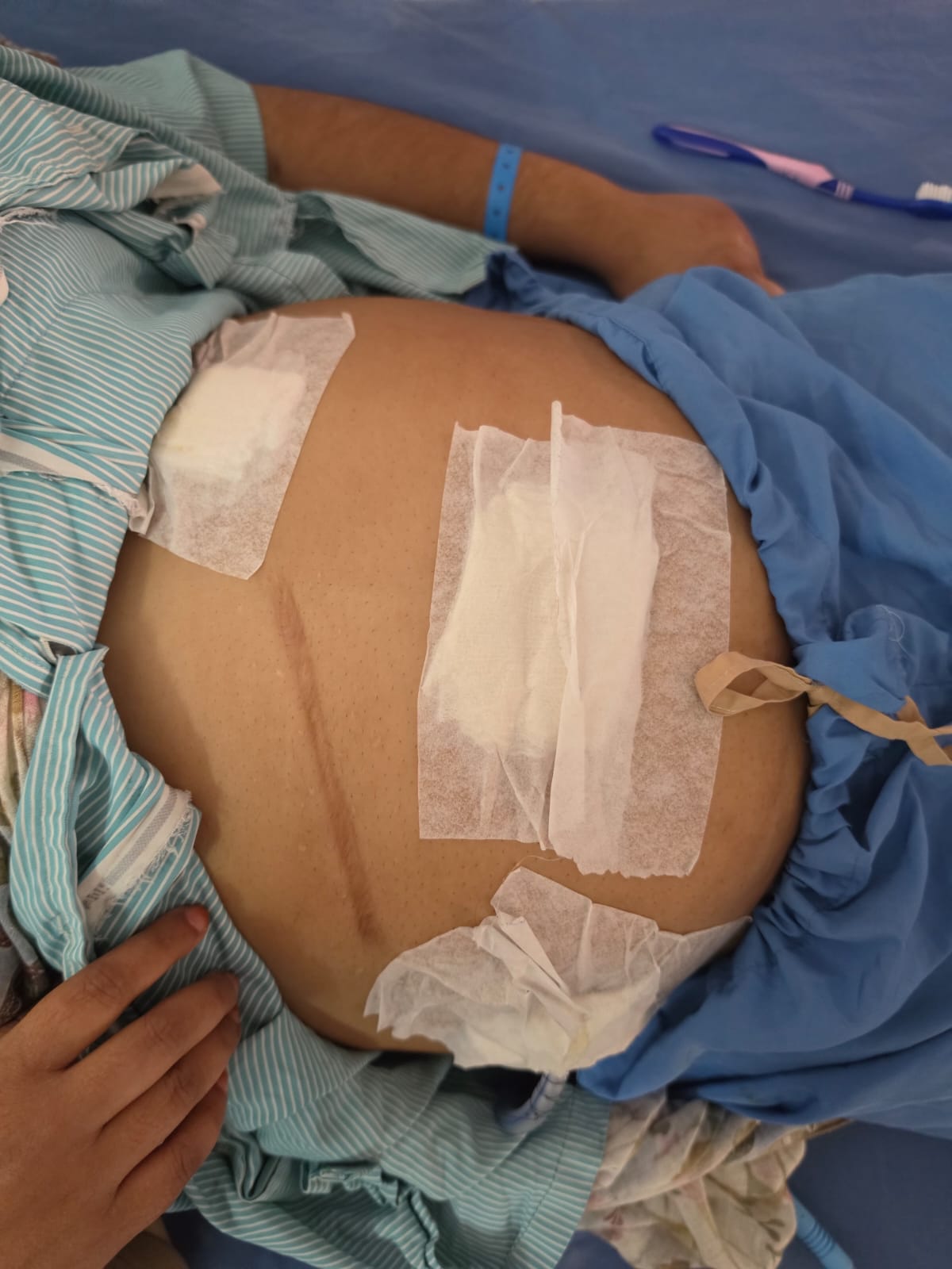 Incisional hernia defect