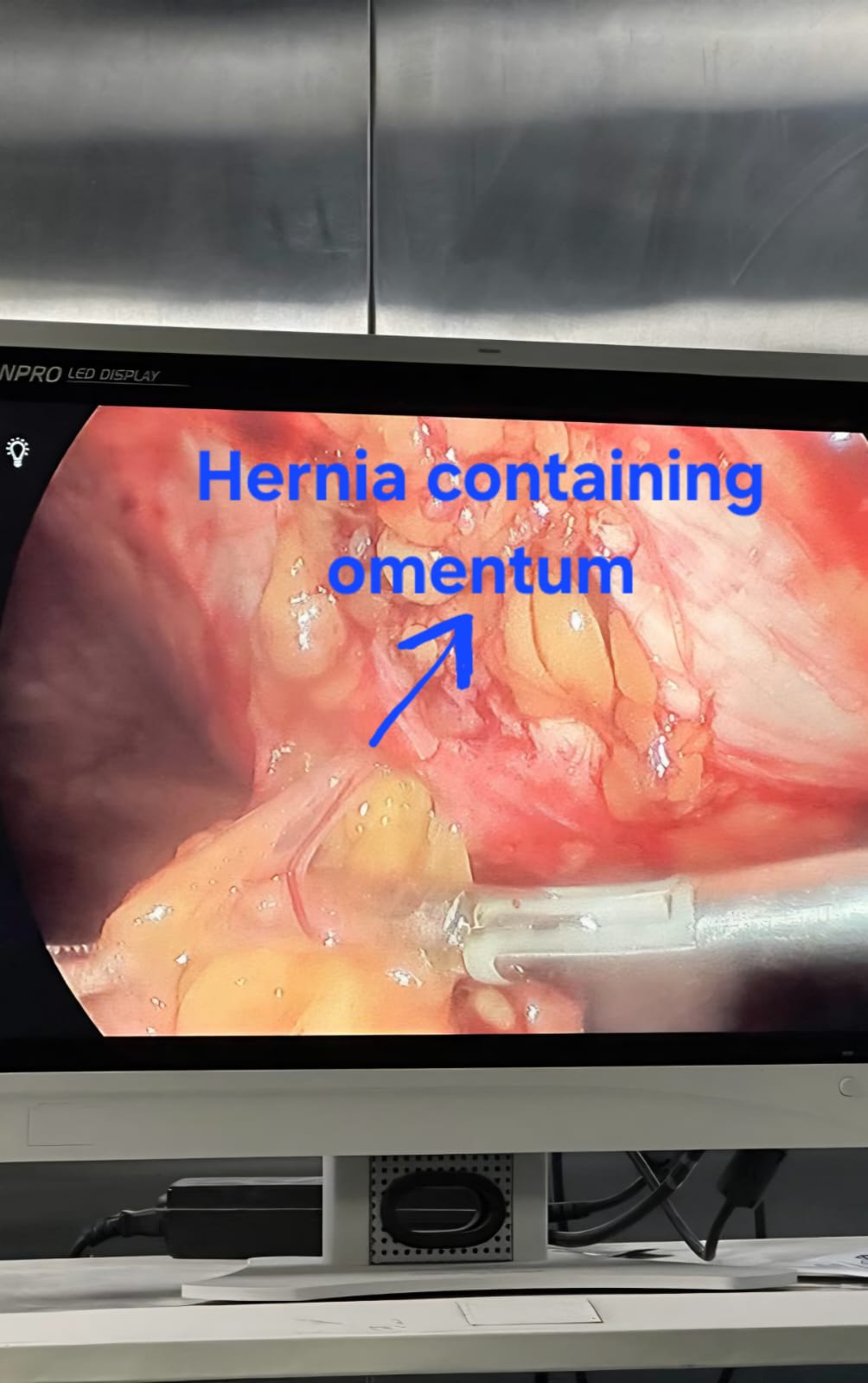 Limberg flap post-op