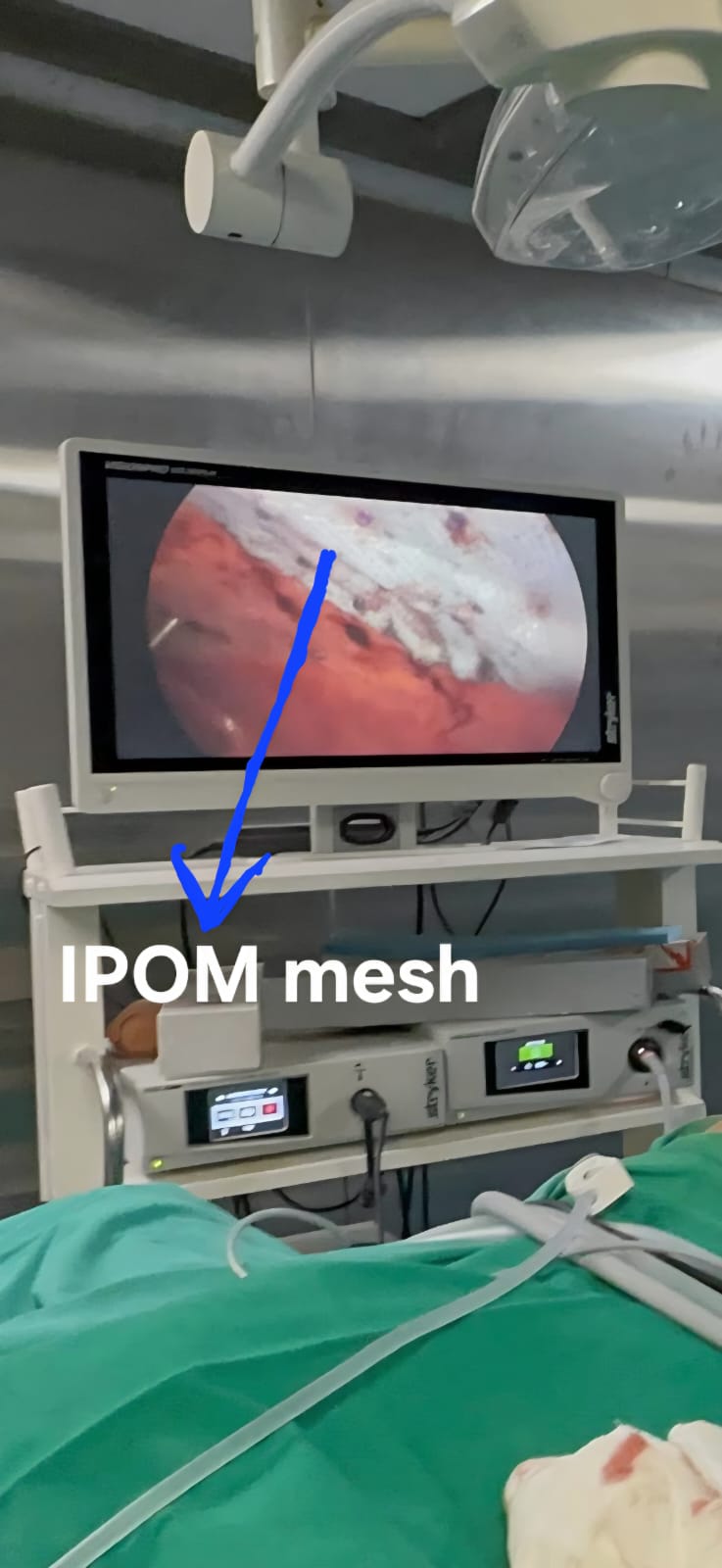 Pilonidal sinus pre-operative